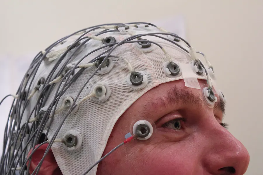 A cap holding electrodes in place to record an EEG, a test used in diagnosing epilepsy.