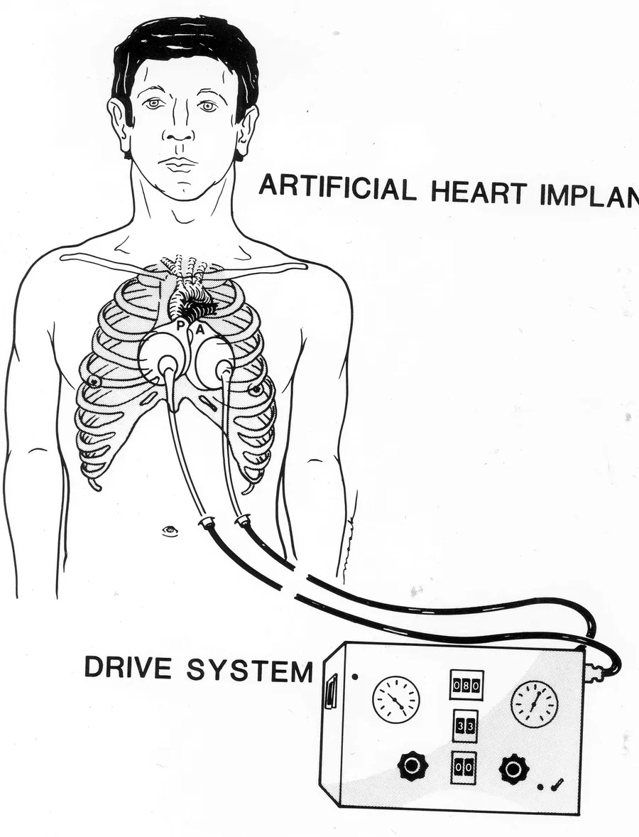 A diagram of the Jarvik-7 artificial heart and its external drive system.