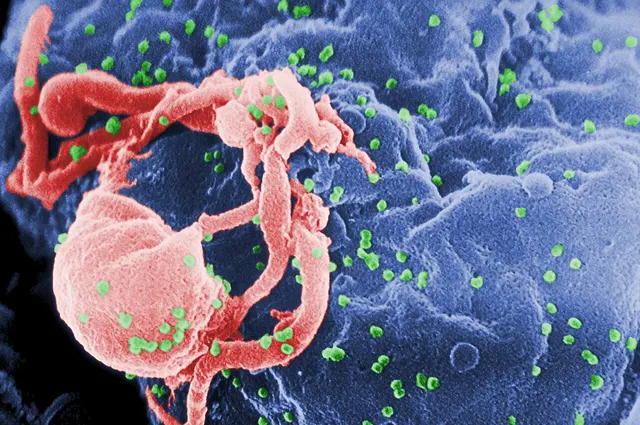 Electron micrograph of HIV particles budding from a human cell