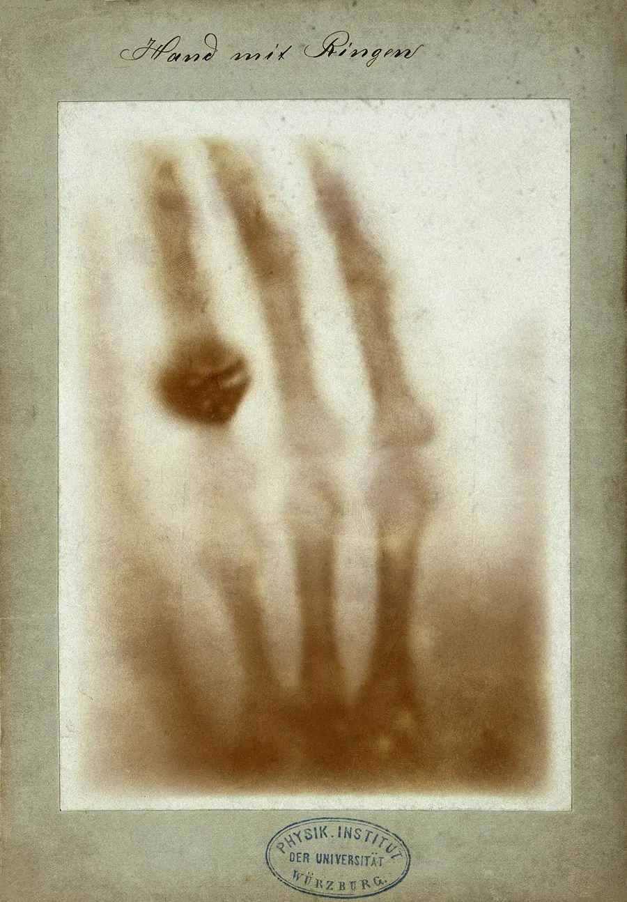 An X-ray of Anna Bertha Röntgen's hand and wedding ring, taken by her husband on 22 December 1895.